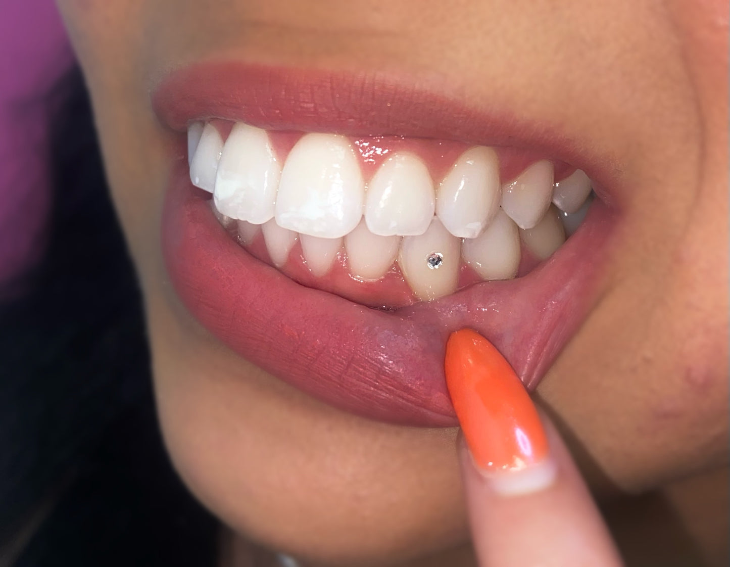 Cosmetic Teeth Whitening