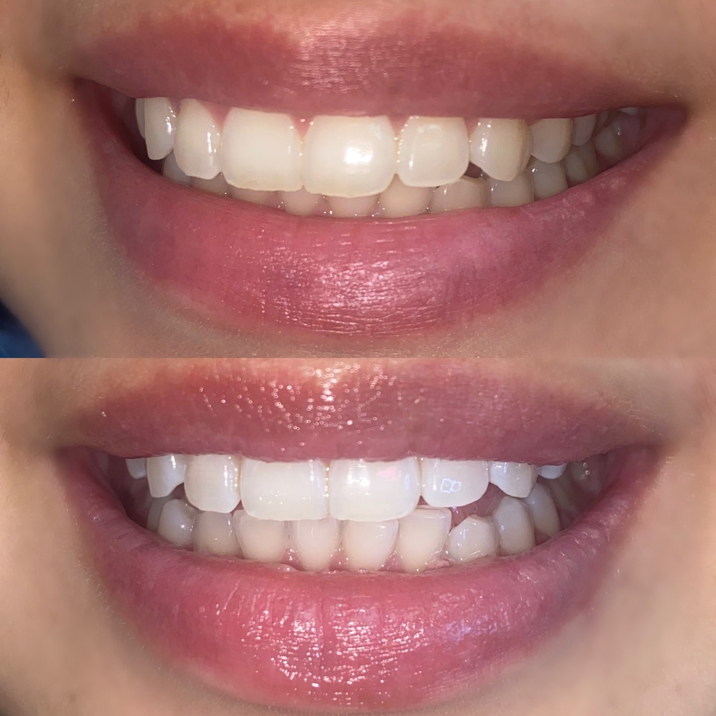 1:1 Teeth Whitening Training & Certification