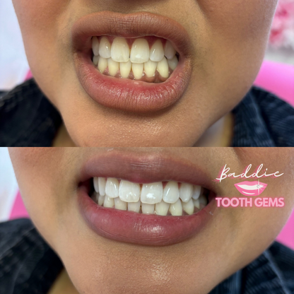 Professional Teeth Whitening System