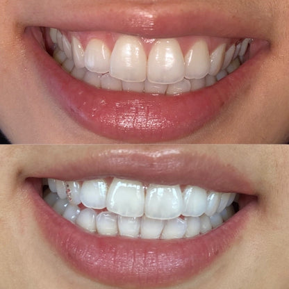 Couples/Besties Teeth Whitening Appointment for 2 Clients SPECIAL PROMO